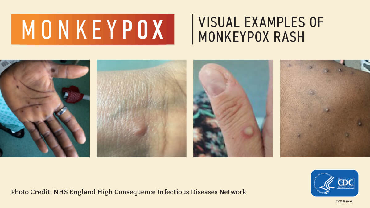 [CREDIT: CDC] Monkeypox is spreading across the U.S. with four known cases in Rhode Island. The virus causes a rash that can occur on the hands and feet, and genitals. It is spread mainly through close, intimate contact.